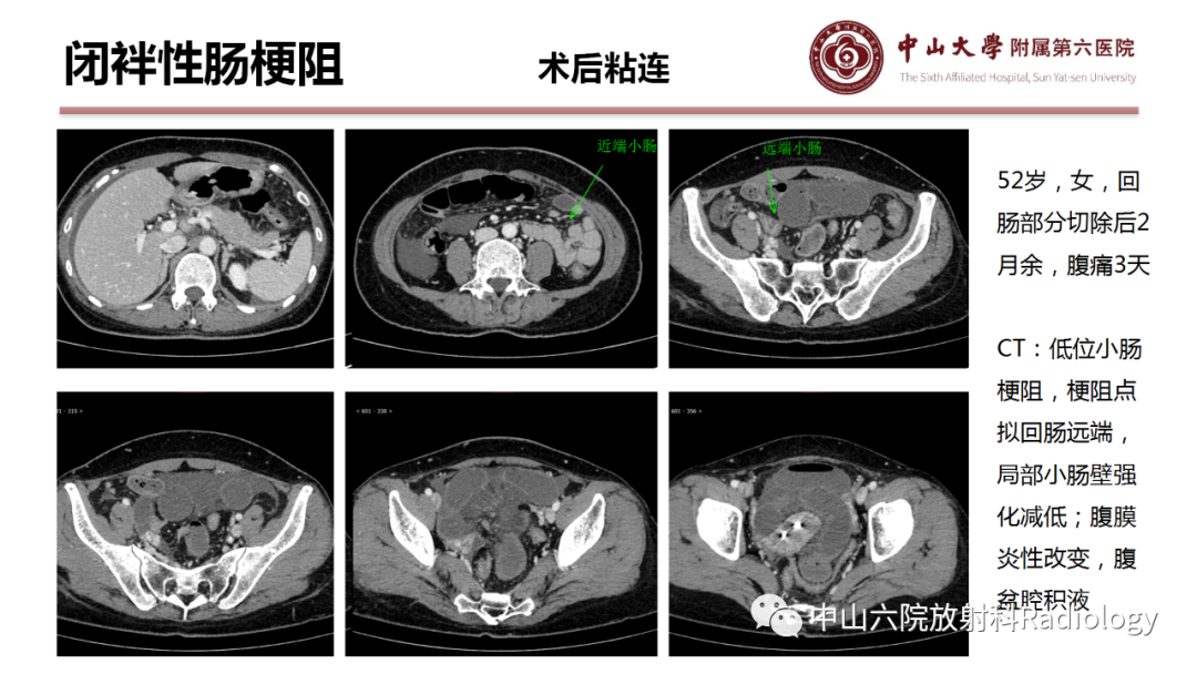 影像PPT - 【PPT】肠梗阻影像学表现与常见病因-9