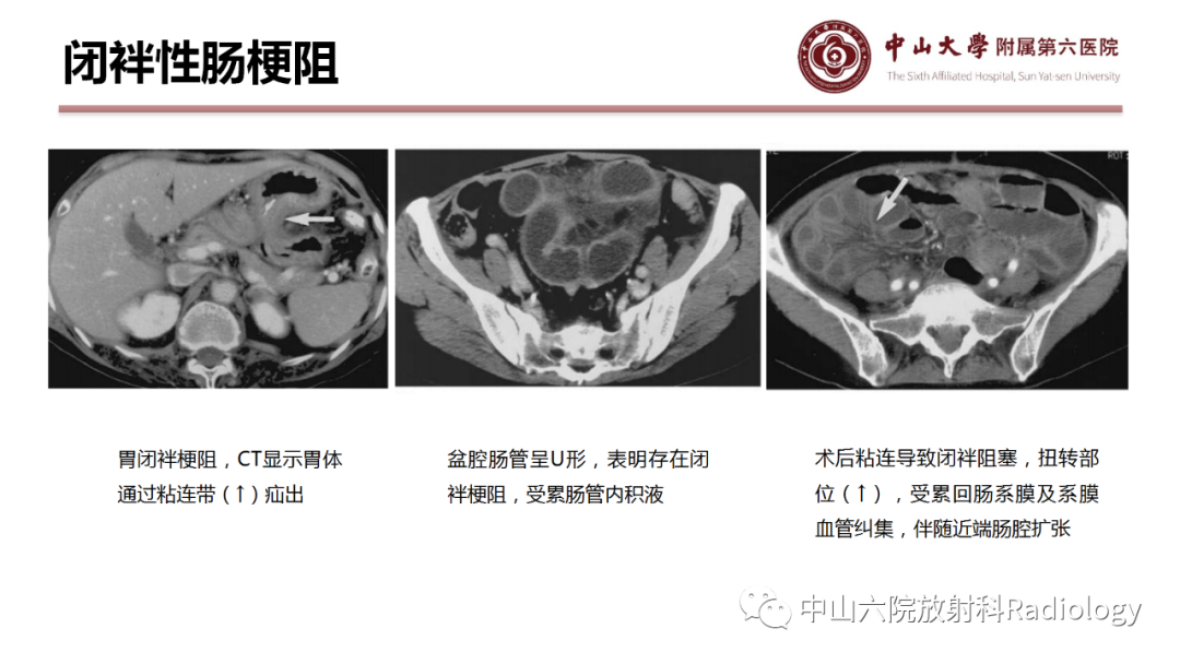 影像PPT - 【PPT】肠梗阻影像学表现与常见病因-10