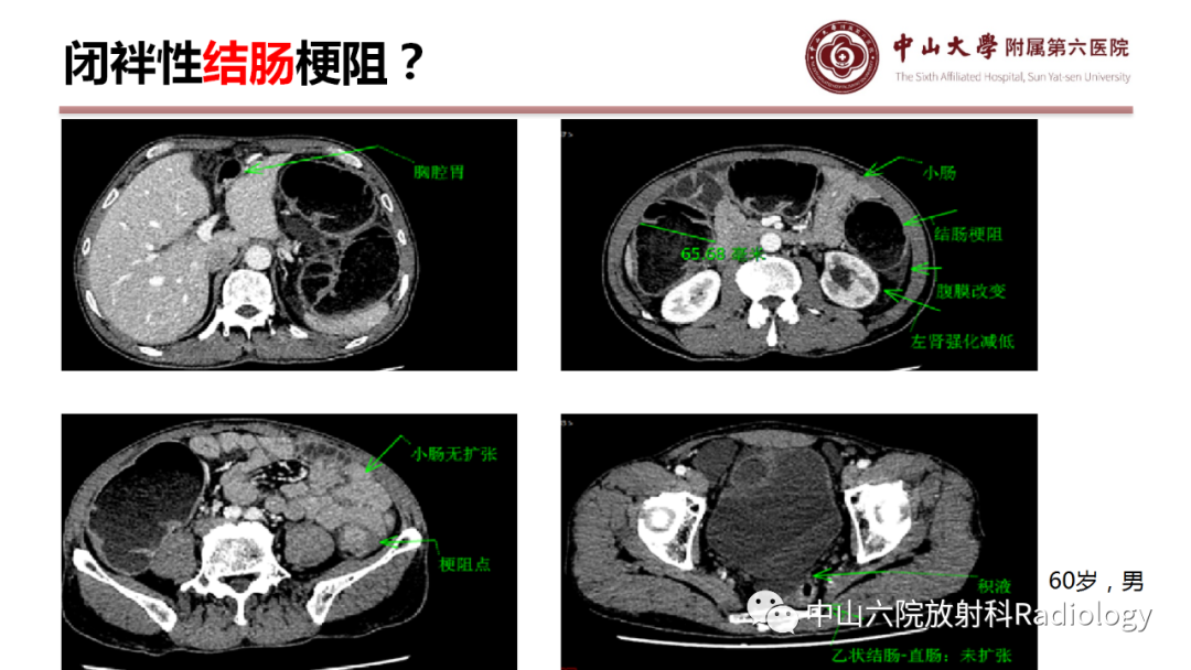 影像PPT - 【PPT】肠梗阻影像学表现与常见病因-11