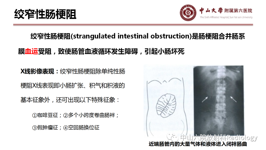 影像PPT - 【PPT】肠梗阻影像学表现与常见病因-13
