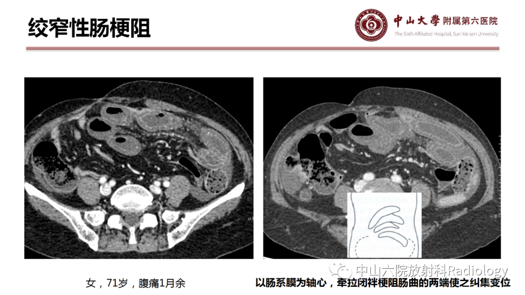 影像PPT - 【PPT】肠梗阻影像学表现与常见病因-15