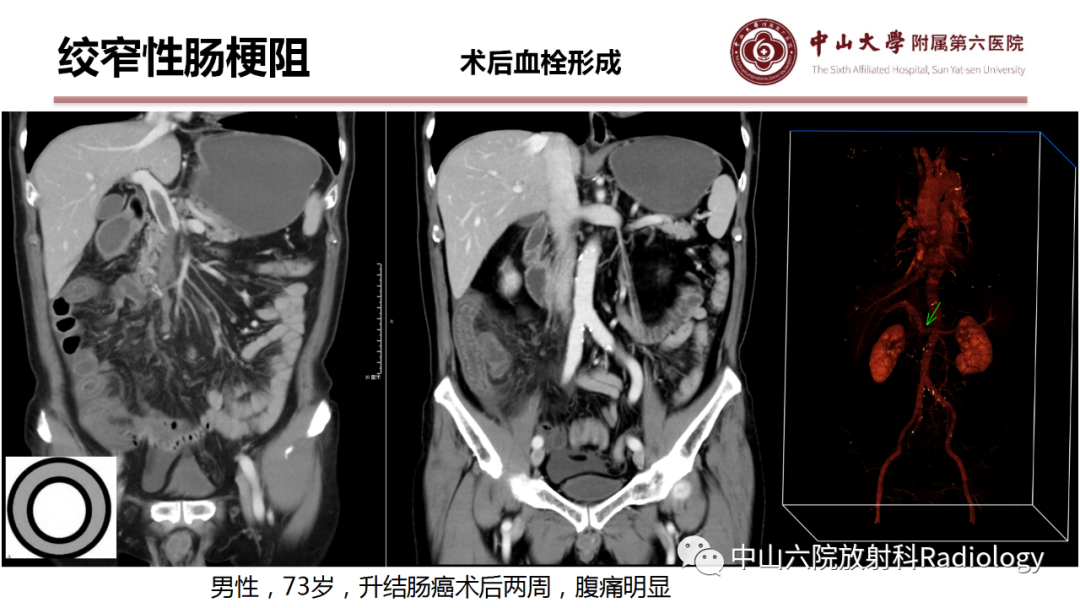 影像PPT - 【PPT】肠梗阻影像学表现与常见病因-16