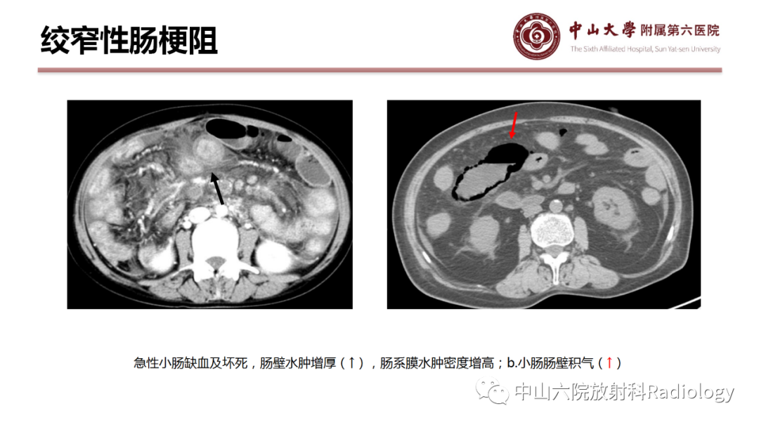 影像PPT - 【PPT】肠梗阻影像学表现与常见病因-17