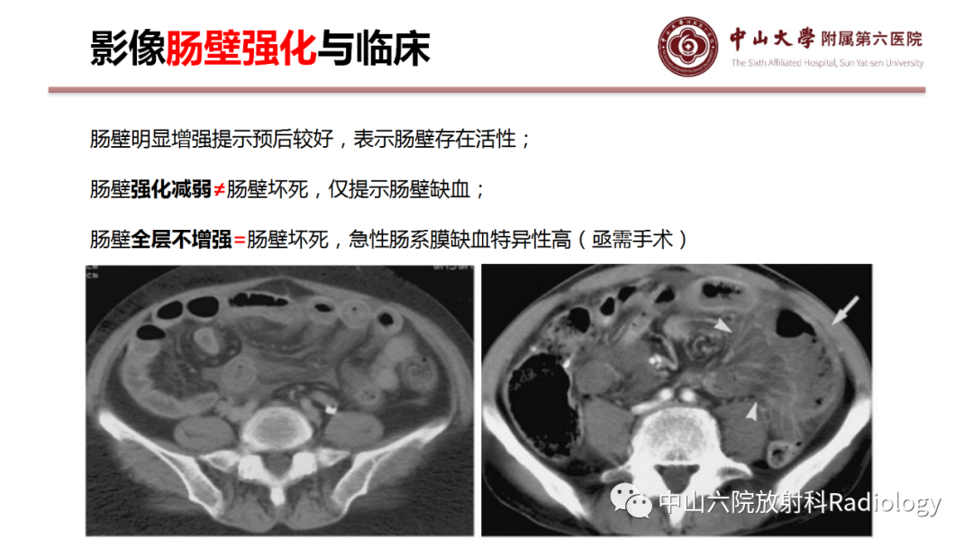 影像PPT - 【PPT】肠梗阻影像学表现与常见病因-18