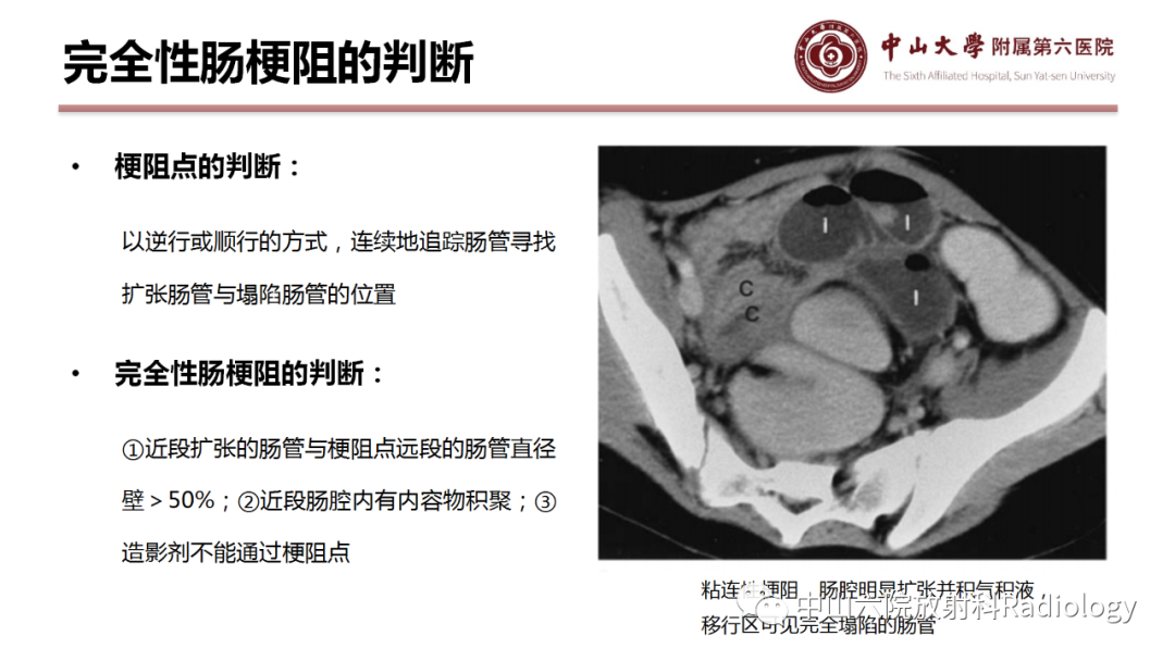 影像PPT - 【PPT】肠梗阻影像学表现与常见病因-19