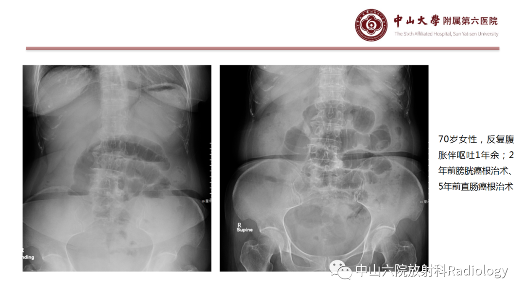 影像PPT - 【PPT】肠梗阻影像学表现与常见病因-23