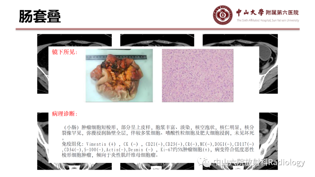 影像PPT - 【PPT】肠梗阻影像学表现与常见病因-28