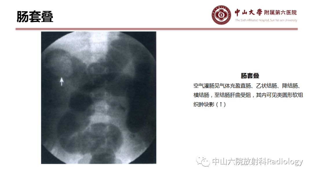影像PPT - 【PPT】肠梗阻影像学表现与常见病因-30