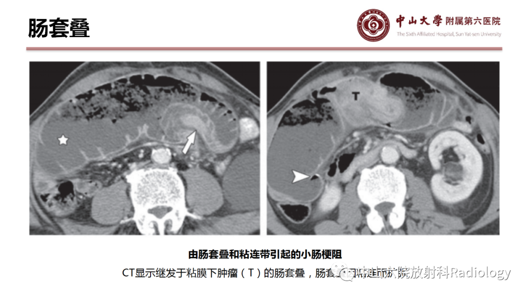 影像PPT - 【PPT】肠梗阻影像学表现与常见病因-31