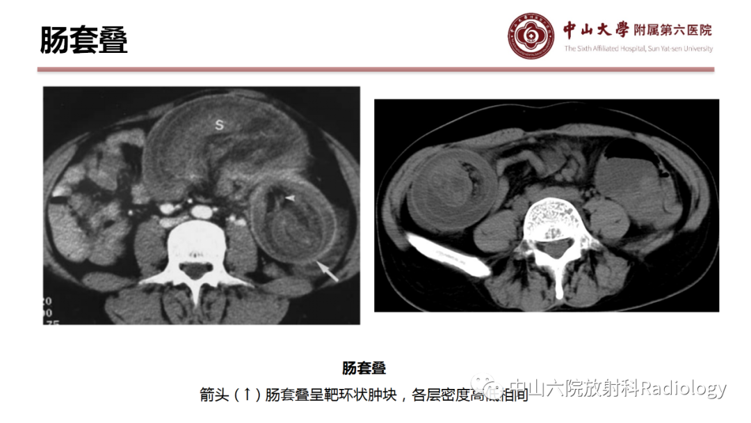 影像PPT - 【PPT】肠梗阻影像学表现与常见病因-32