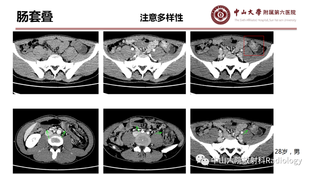 影像PPT - 【PPT】肠梗阻影像学表现与常见病因-33
