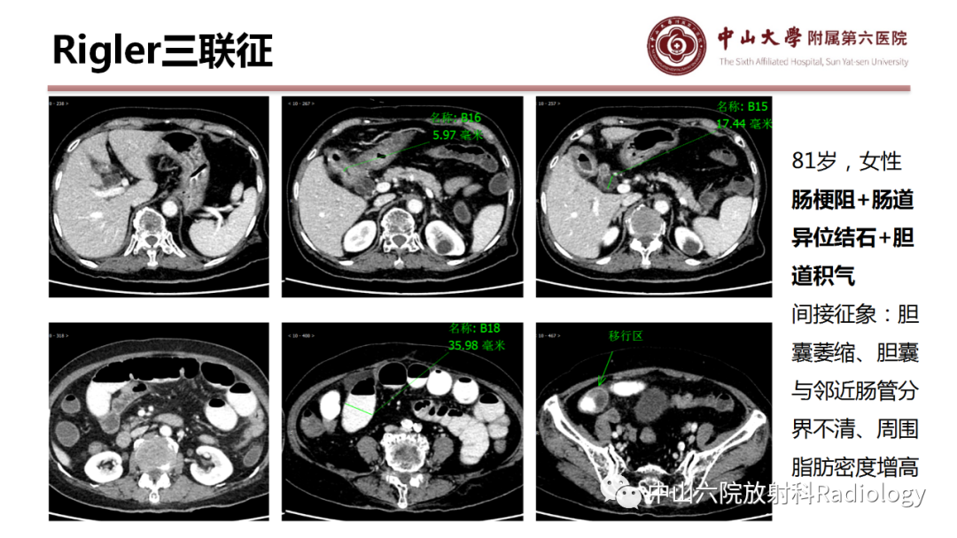 影像PPT - 【PPT】肠梗阻影像学表现与常见病因-37