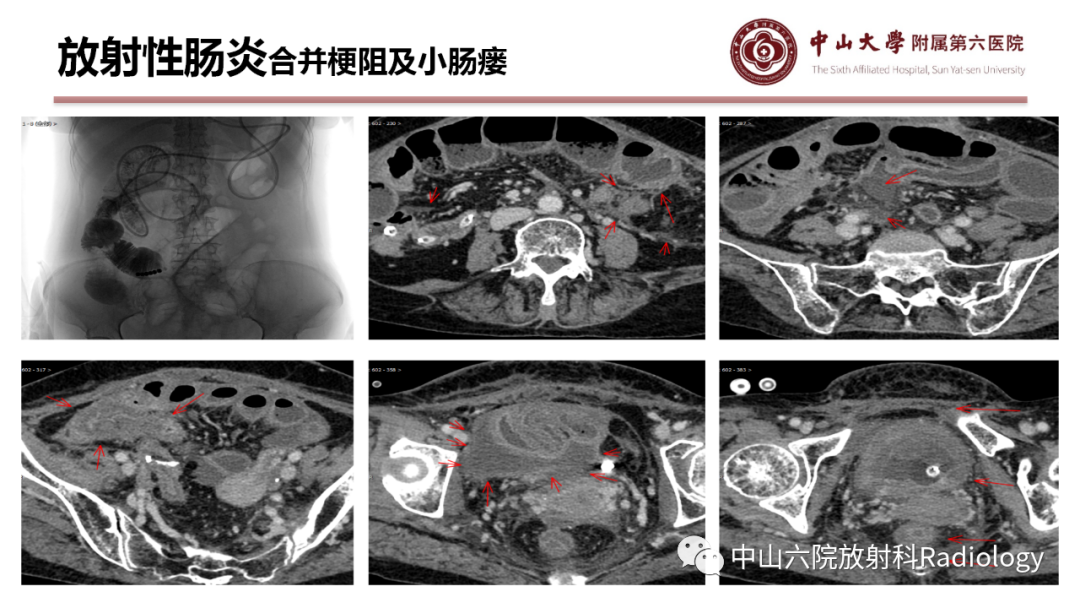 影像PPT - 【PPT】肠梗阻影像学表现与常见病因-39