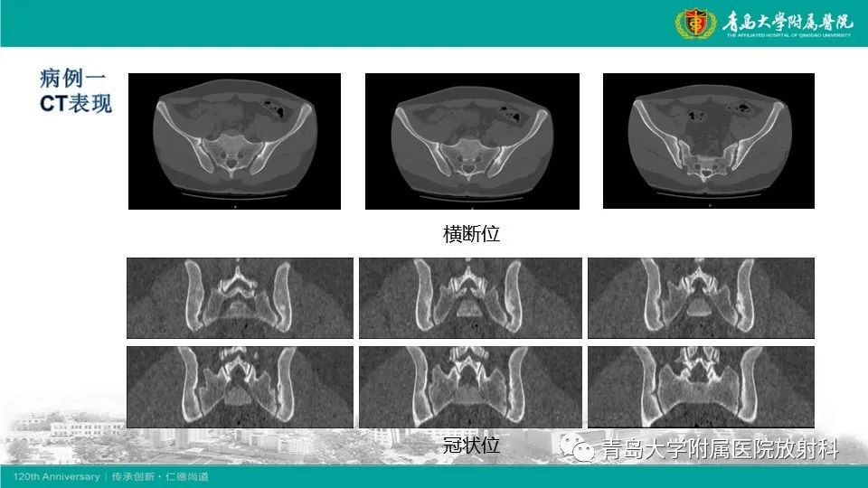 影像PPT - 【PPT】强直性脊柱炎-4