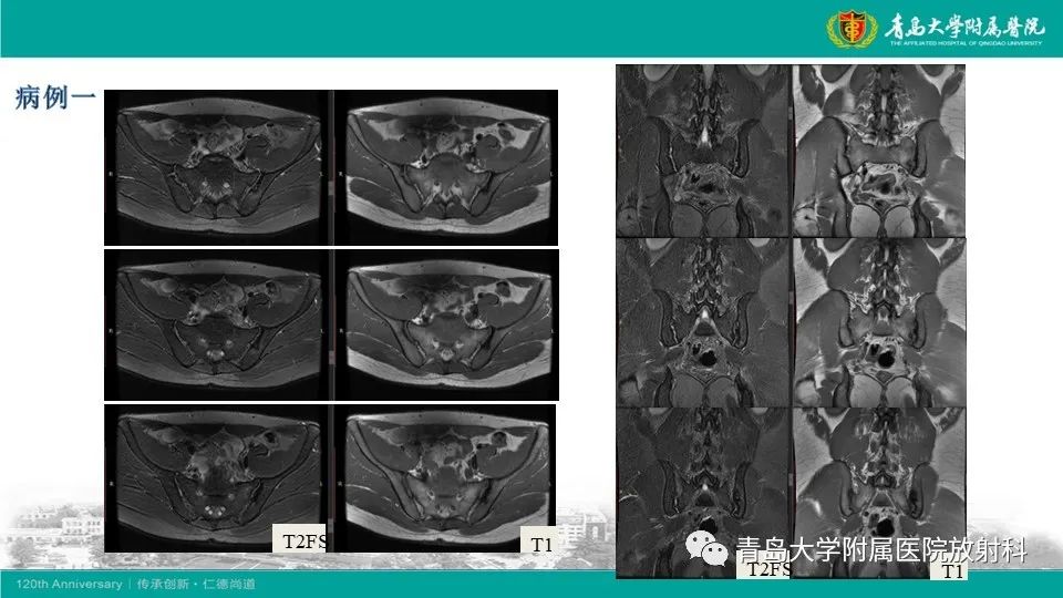 影像PPT - 【PPT】强直性脊柱炎-5