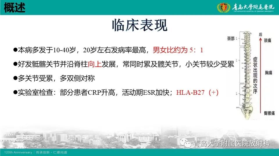 影像PPT - 【PPT】强直性脊柱炎-10