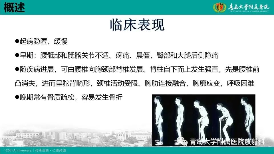 影像PPT - 【PPT】强直性脊柱炎-11