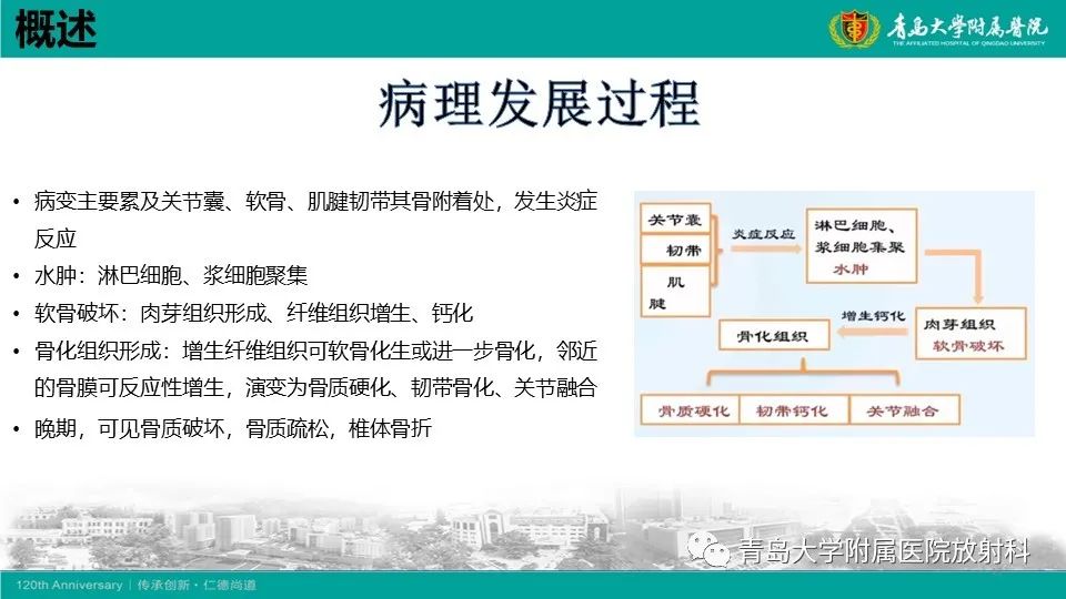 影像PPT - 【PPT】强直性脊柱炎-12