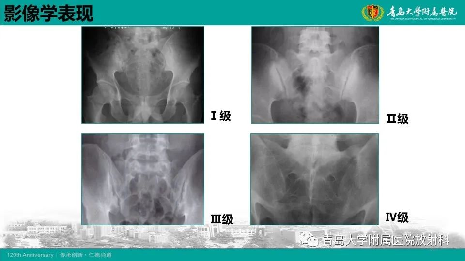 影像PPT - 【PPT】强直性脊柱炎-15