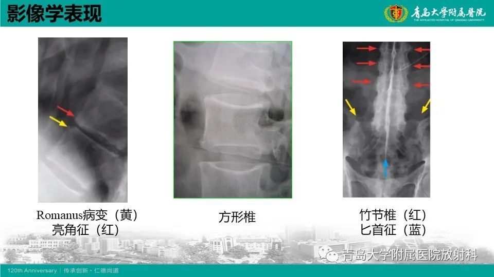 影像PPT - 【PPT】强直性脊柱炎-17
