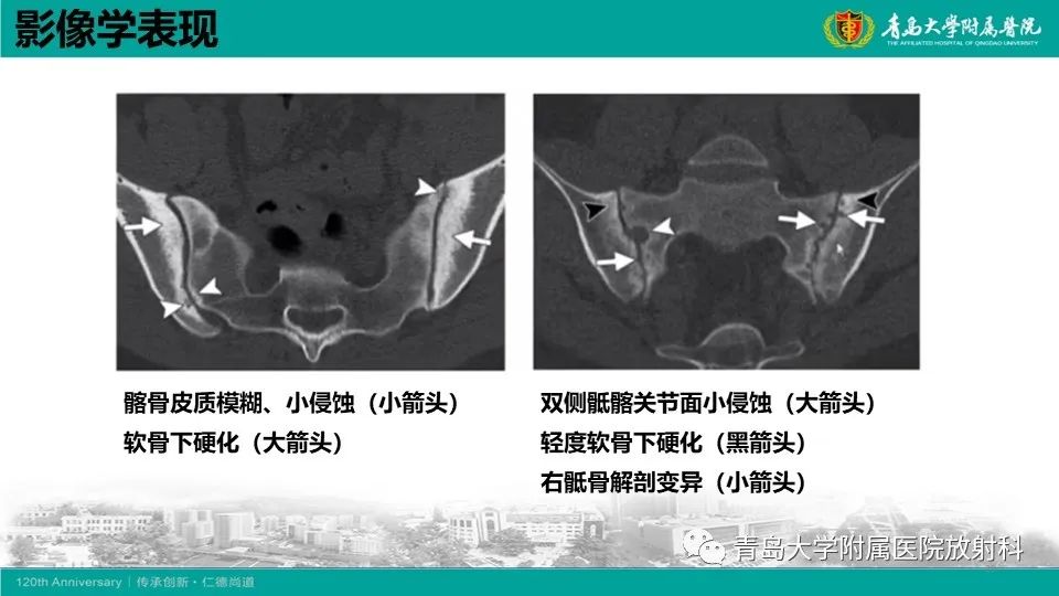 影像PPT - 【PPT】强直性脊柱炎-19