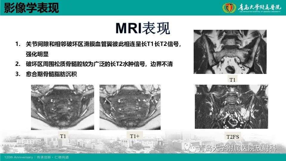 影像PPT - 【PPT】强直性脊柱炎-20