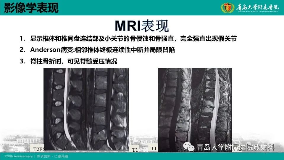 影像PPT - 【PPT】强直性脊柱炎-21