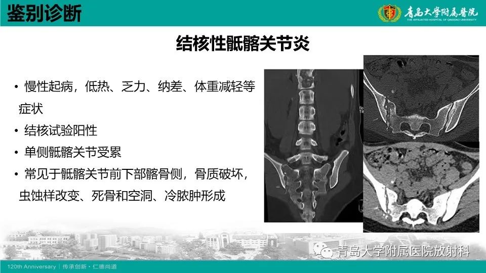 影像PPT - 【PPT】强直性脊柱炎-25