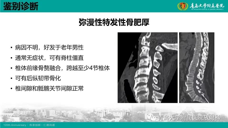 影像PPT - 【PPT】强直性脊柱炎-26