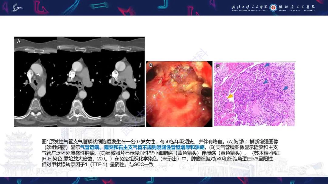 影像PPT - 【PPT】气管支气管肿瘤影像诊断-11