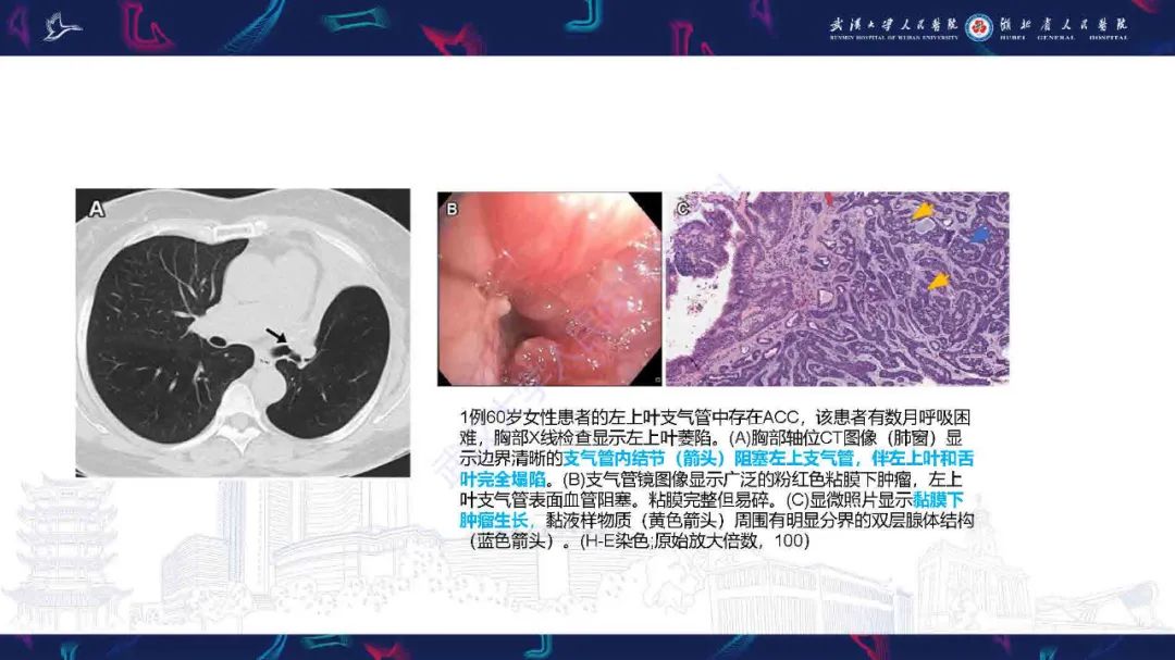 影像PPT - 【PPT】气管支气管肿瘤影像诊断-14