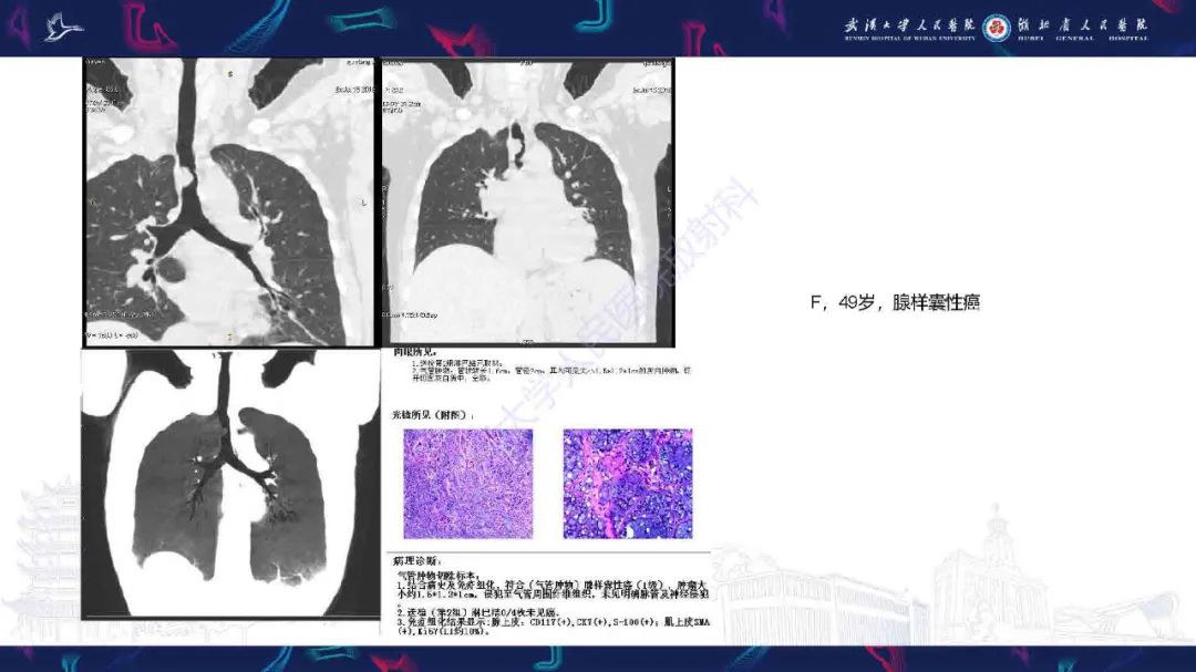 影像PPT - 【PPT】气管支气管肿瘤影像诊断-15