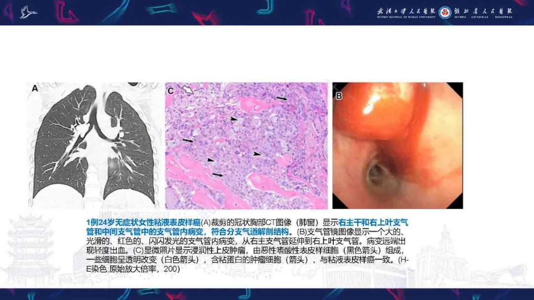 影像PPT - 【PPT】气管支气管肿瘤影像诊断-18
