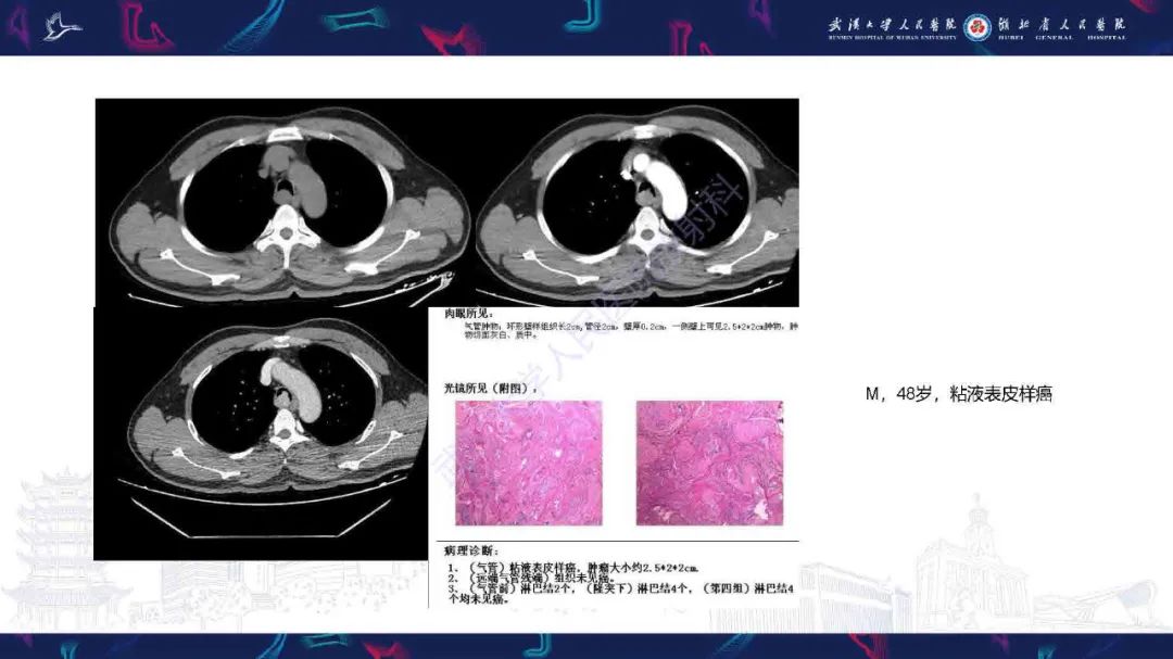 影像PPT - 【PPT】气管支气管肿瘤影像诊断-19