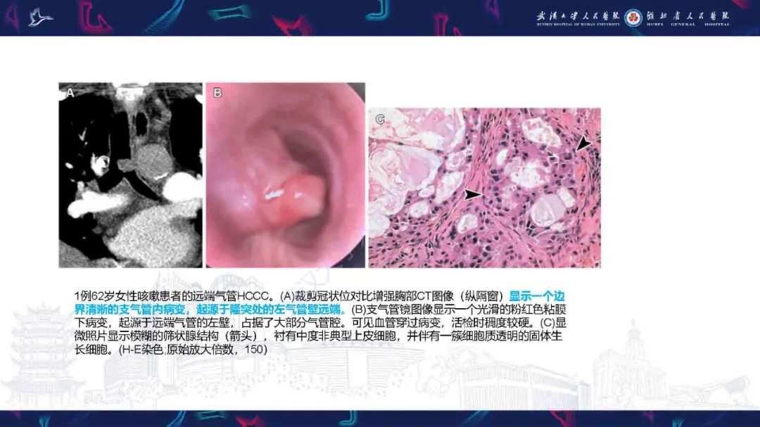 影像PPT - 【PPT】气管支气管肿瘤影像诊断-21