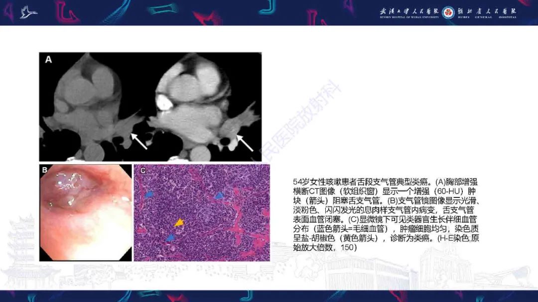 影像PPT - 【PPT】气管支气管肿瘤影像诊断-25