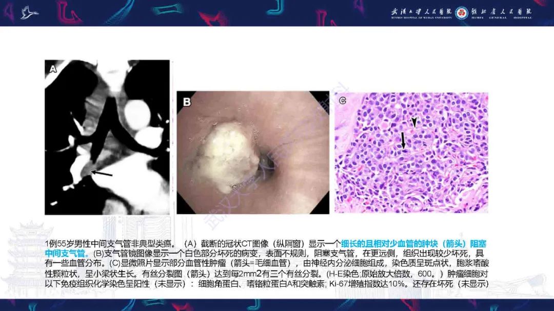 影像PPT - 【PPT】气管支气管肿瘤影像诊断-26