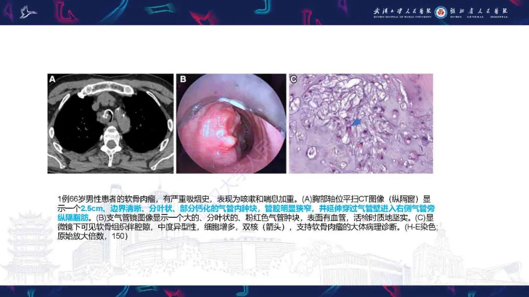 影像PPT - 【PPT】气管支气管肿瘤影像诊断-28