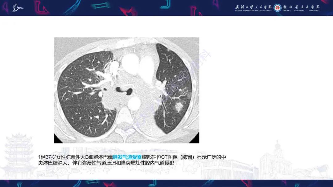 影像PPT - 【PPT】气管支气管肿瘤影像诊断-30