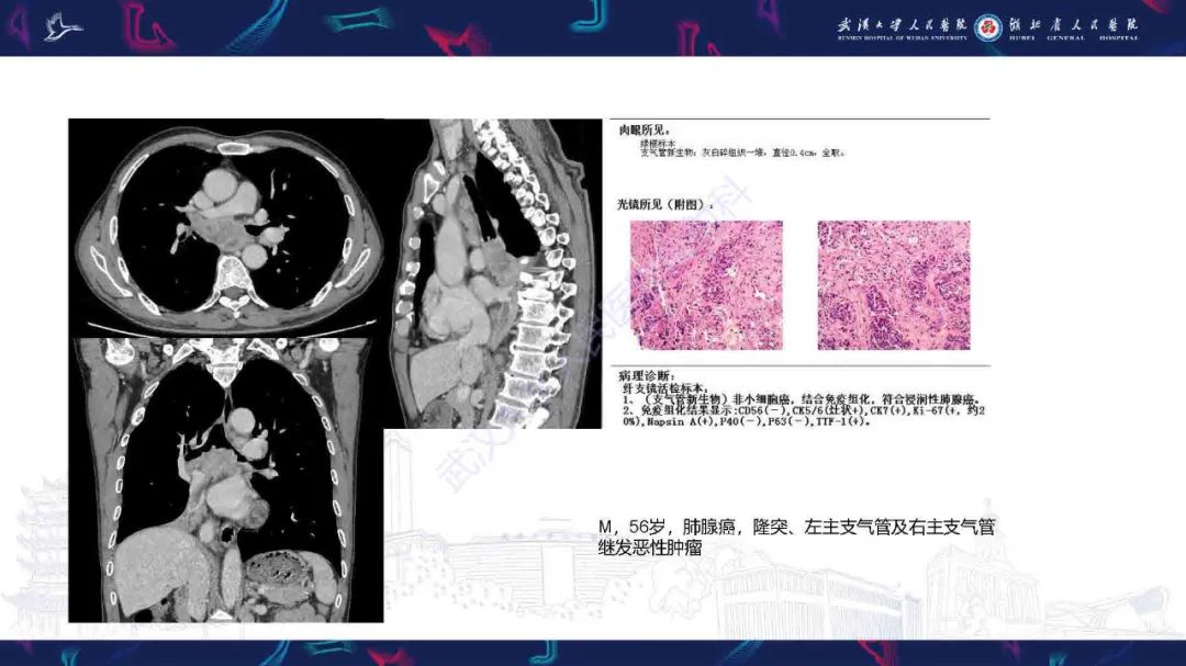 影像PPT - 【PPT】气管支气管肿瘤影像诊断-34