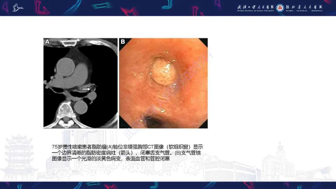 影像PPT - 【PPT】气管支气管肿瘤影像诊断-40