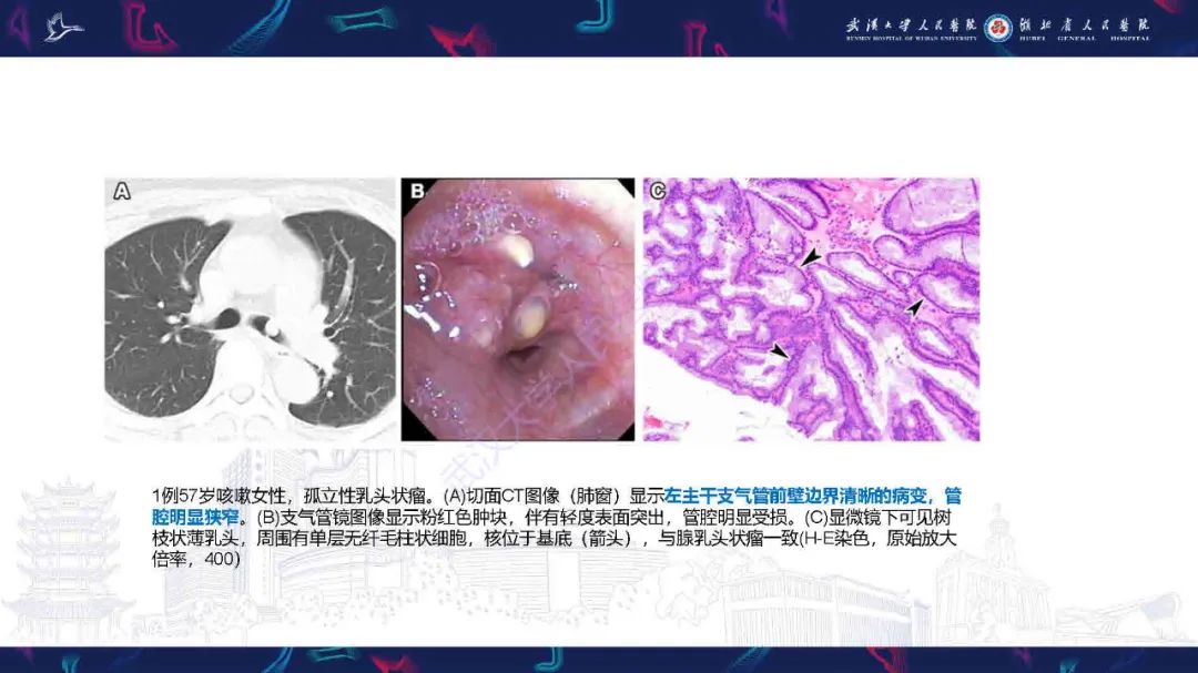 影像PPT - 【PPT】气管支气管肿瘤影像诊断-43