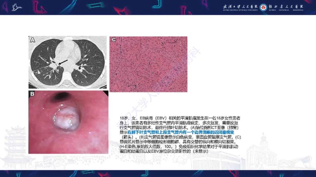 影像PPT - 【PPT】气管支气管肿瘤影像诊断-47