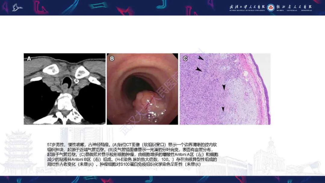影像PPT - 【PPT】气管支气管肿瘤影像诊断-49