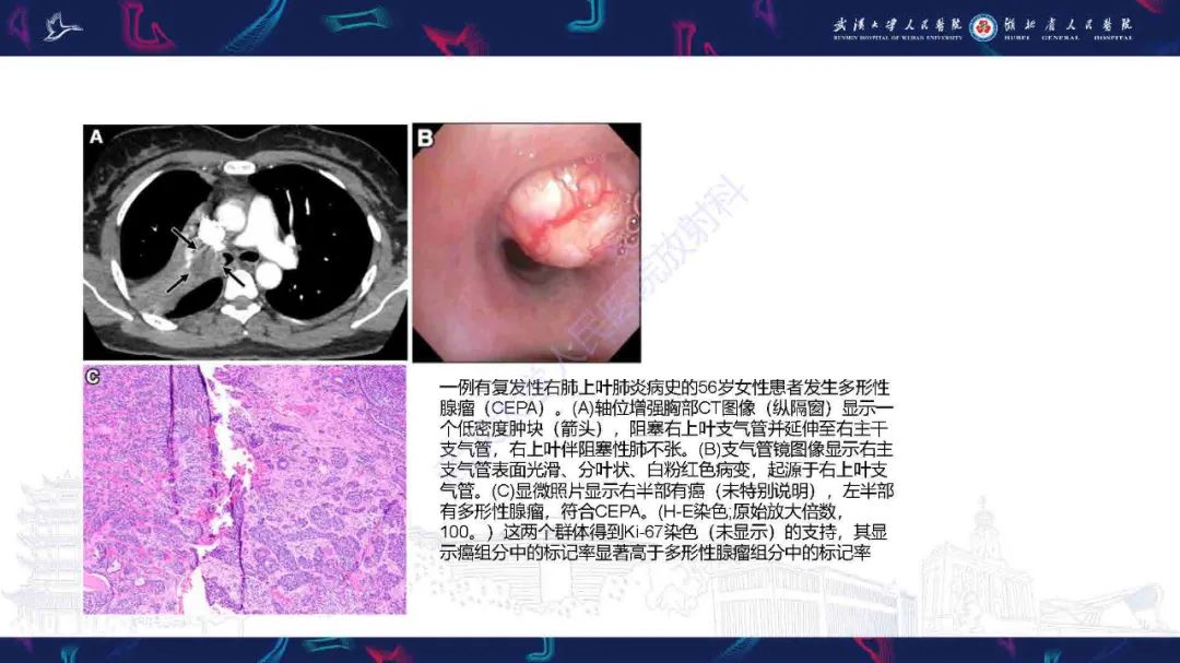 影像PPT - 【PPT】气管支气管肿瘤影像诊断-51