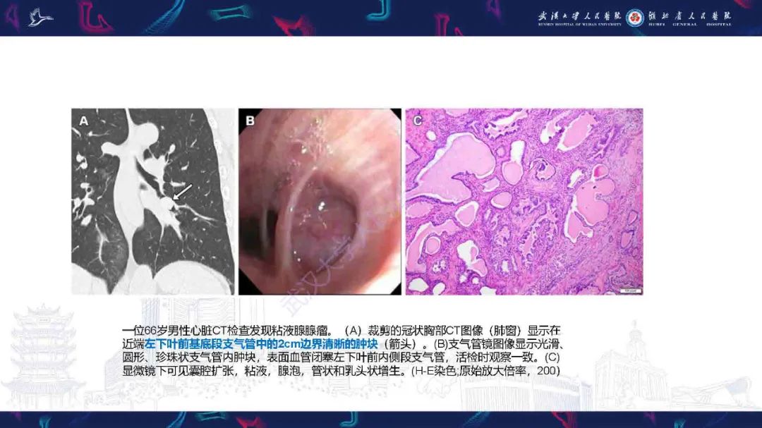 影像PPT - 【PPT】气管支气管肿瘤影像诊断-53
