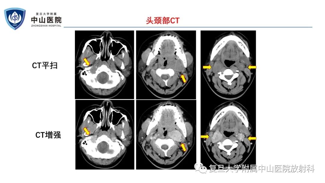 影像PPT - 【病例】肾上腺嗜铬细胞瘤伴转移1例CT及MR影像-3