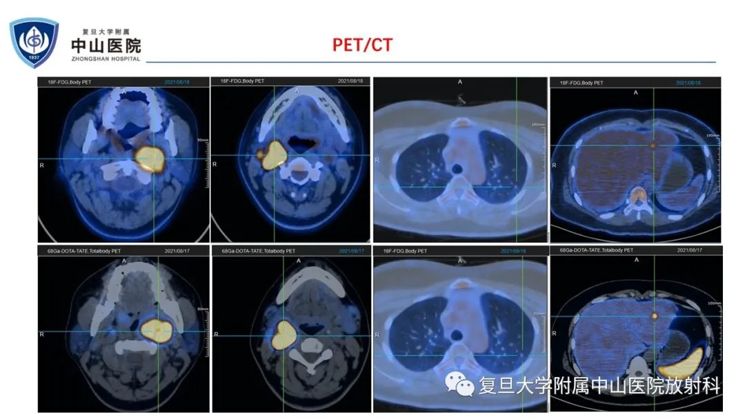 影像PPT - 【病例】肾上腺嗜铬细胞瘤伴转移1例CT及MR影像-7