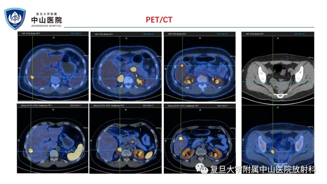 影像PPT - 【病例】肾上腺嗜铬细胞瘤伴转移1例CT及MR影像-8