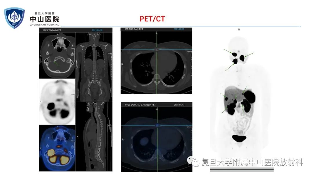影像PPT - 【病例】肾上腺嗜铬细胞瘤伴转移1例CT及MR影像-9